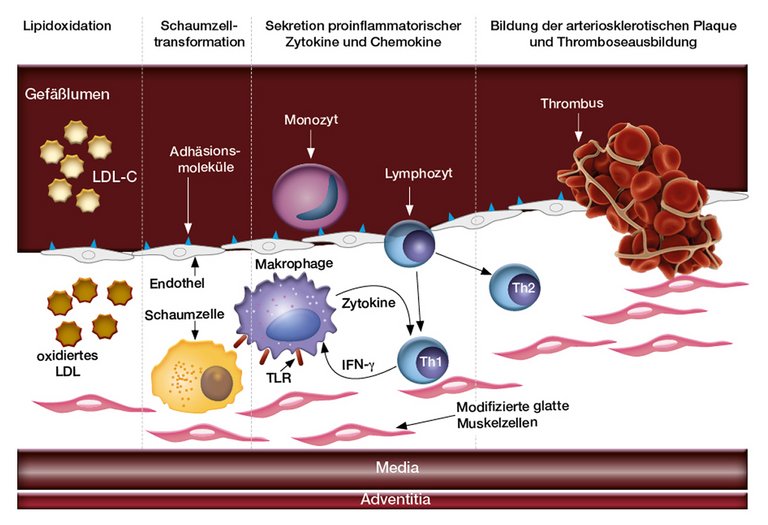 Vereinfachte Darstellung der Entstehung einer atherosklerotischen Plaque