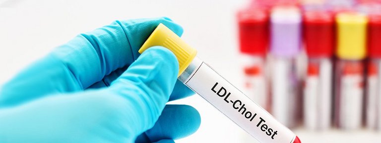 Hand hält einen LDL-Chol Test 