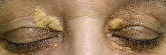 Geschlossene Augen einer Frau mit familiärer Hypercholesterinämie