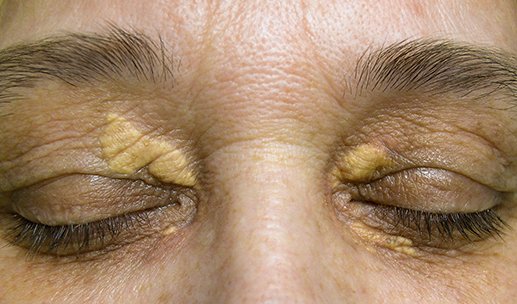Geschlossene Augen einer Frau mit familiärer Hypercholesterinämie